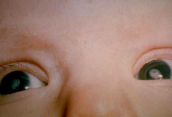 The Truth about Cataracts in Babies