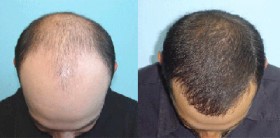 All You Need to Know About Hair Transplantation
