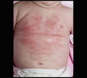 How to Help Children Cope with Allergies while at School