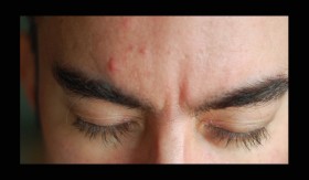 Best Ways to Naturally Prevent and Treat Acne